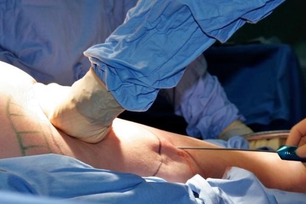 عيادات تجميل في قطر _ الرعاية بعد عملية شفط الدهون