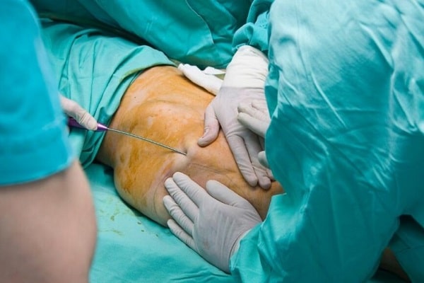 عیادات تجمیل فی قطر _ شفط الدهون من الفخذين والأرداف