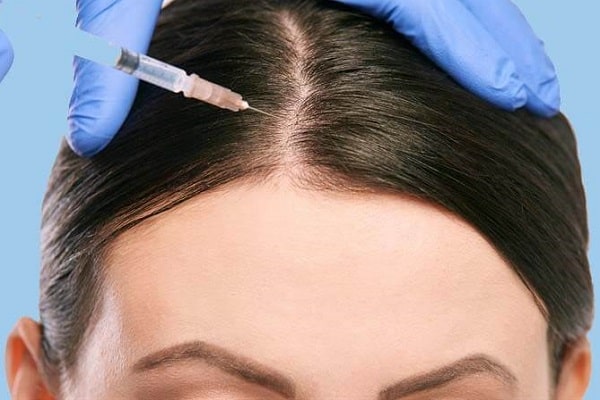 افضل مركز تجميل في بغداد؛ الميزوثيرابي هو وسيلة لعلاج تساقط الشعر